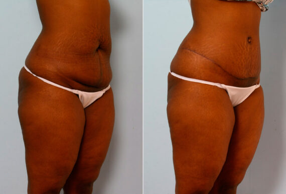 Tummy Tuck/Abdominoplasty before and after photos in Houston, TX, Patient 24232