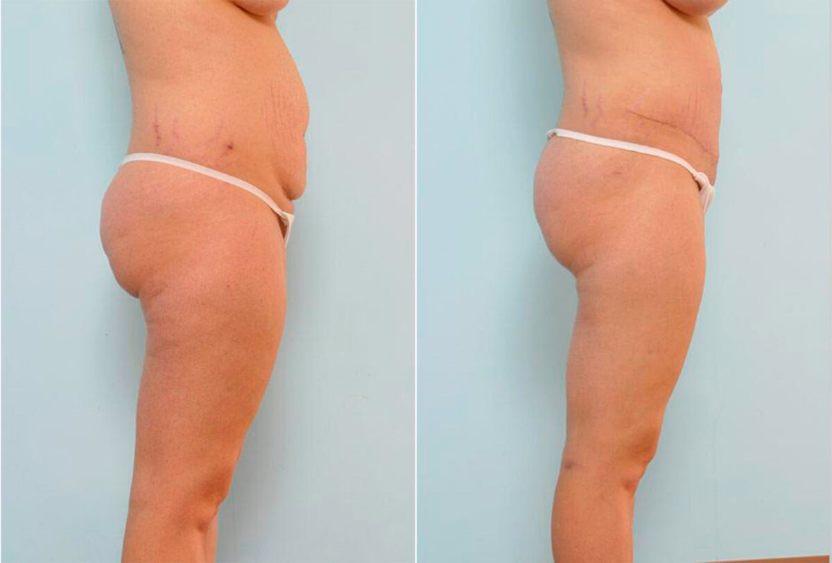 Abdominoplasty before and after photos in Houston, TX, Patient 24559