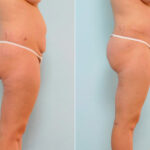 Abdominoplasty before and after photos in Houston, TX, Patient 24559