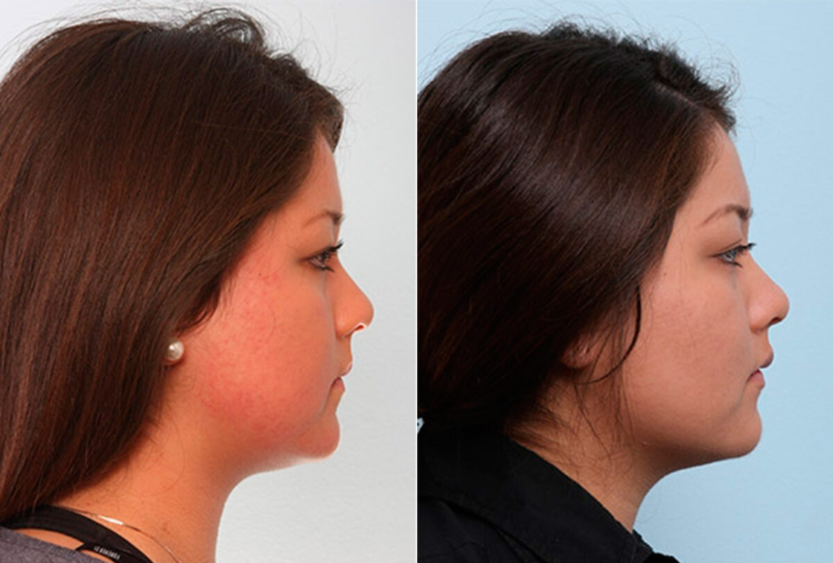 Buccal Fat Pad Removal before and after photos in Houston, TX, Patient 27845