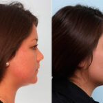 Buccal Fat Pad Removal before and after photos in Houston, TX, Patient 27845