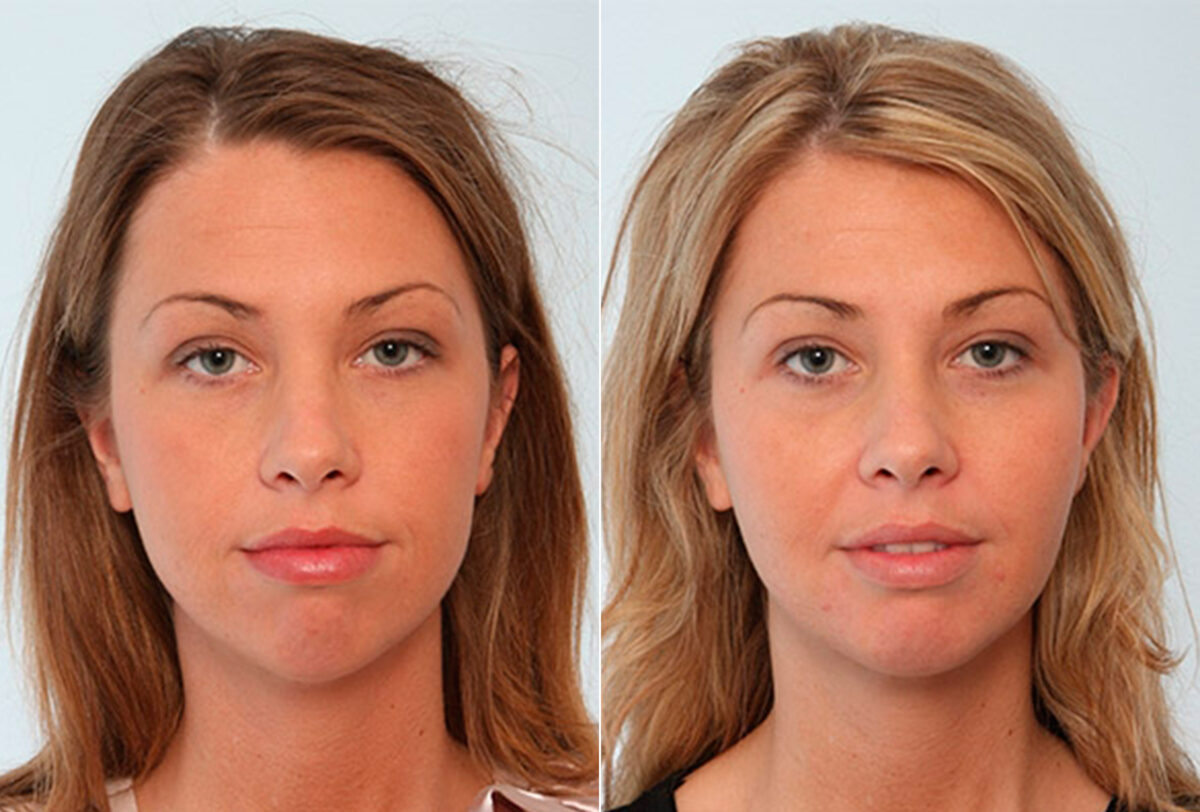 Buccal Fat Pad Removal before and after photos in Houston, TX, Patient 27852