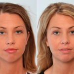 Buccal Fat Pad Removal before and after photos in Houston, TX, Patient 27852