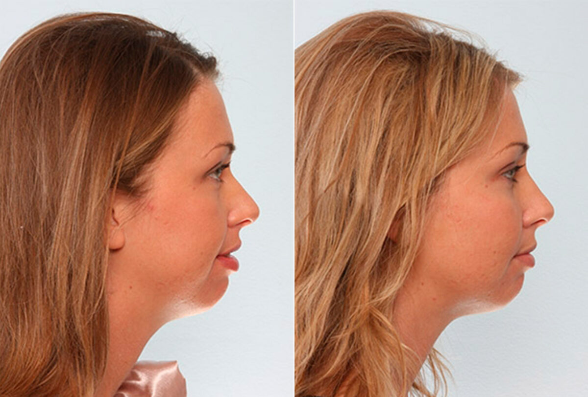 Buccal Fat Pad Removal before and after photos in Houston, TX, Patient 27852