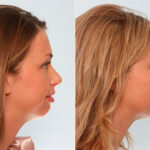 Buccal Fat Pad Removal before and after photos in Houston, TX, Patient 27852