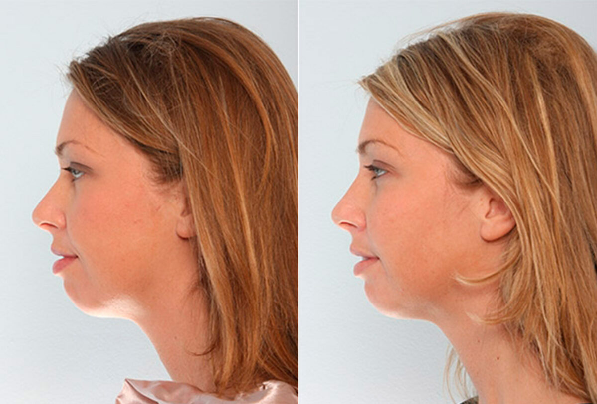 Buccal Fat Pad Removal before and after photos in Houston, TX, Patient 27852