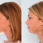 Buccal Fat Pad Removal before and after photos in Houston, TX, Patient 27852