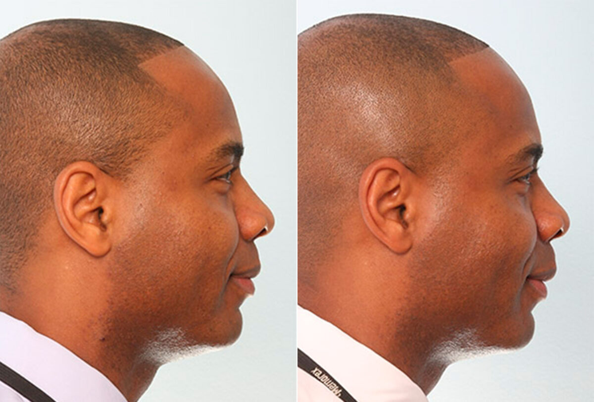 Buccal Fat Pad Removal before and after photos in Houston, TX, Patient 27859