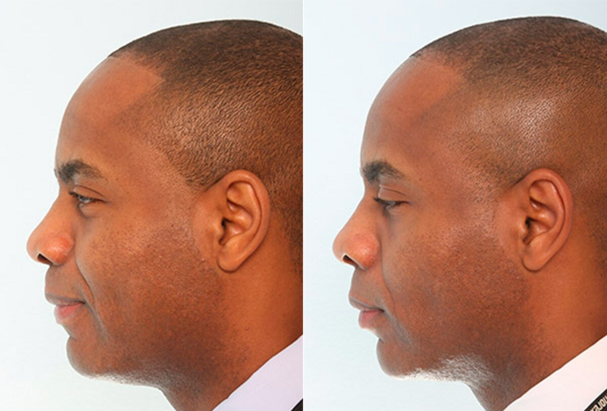 Buccal Fat Pad Removal before and after photos in Houston, TX, Patient 27859