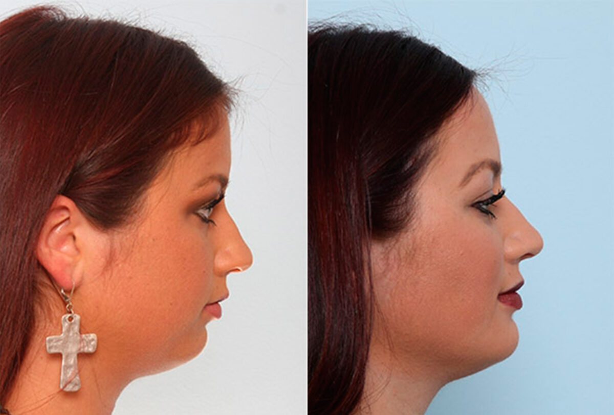 Buccal Fat Pad Removal before and after photos in Houston, TX, Patient 27866