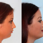 Buccal Fat Pad Removal Photos Houston Tx Patient 27866