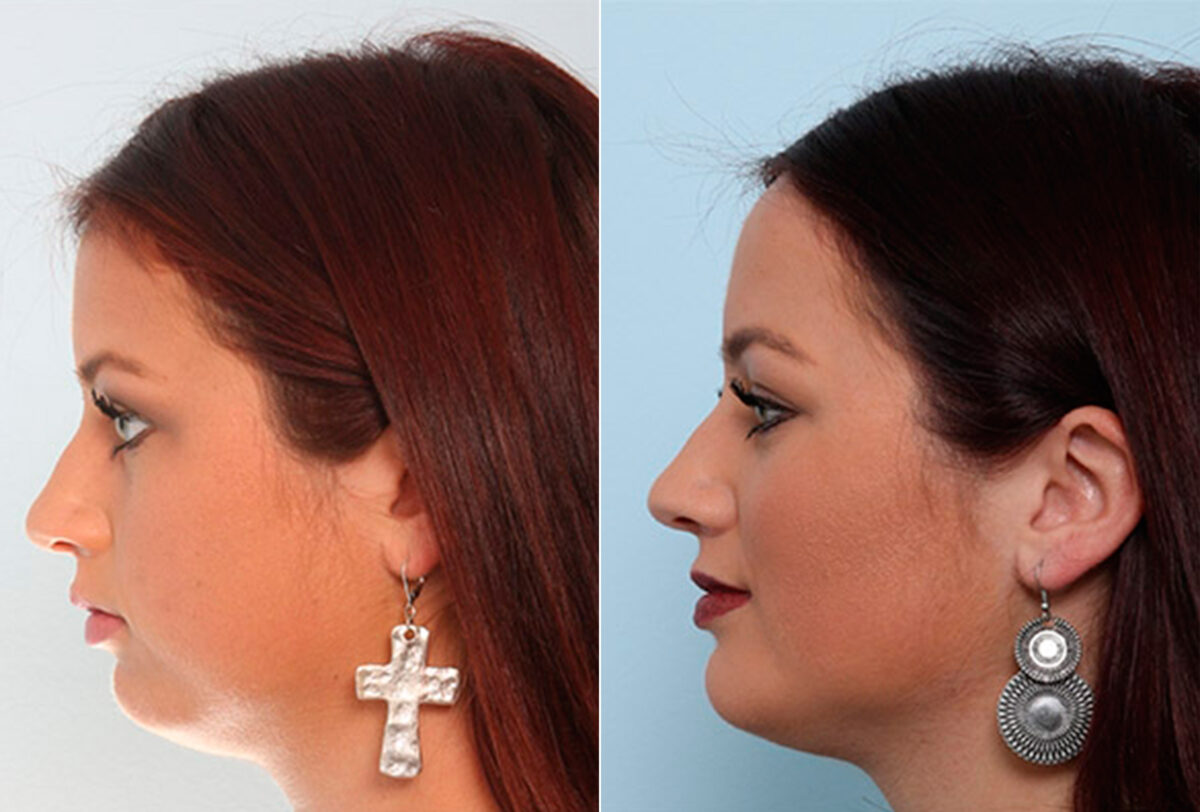 Buccal Fat Pad Removal before and after photos in Houston, TX, Patient 27866
