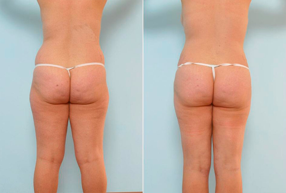 Abdominoplasty before and after photos in Houston, TX, Patient 24559