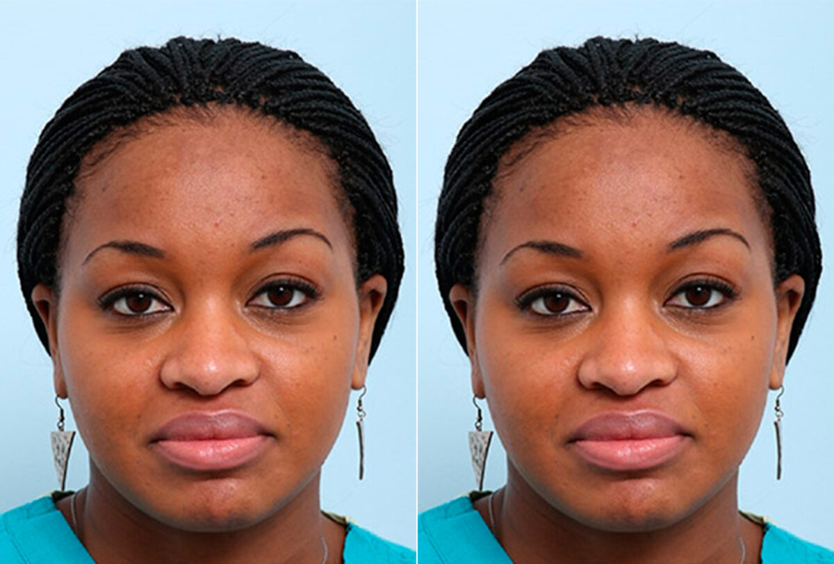 Buccal Fat Pad Removal Photos, Houston, Tx