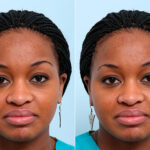 Buccal Fat Pad Removal before and after photos in Houston, TX, Patient 27873