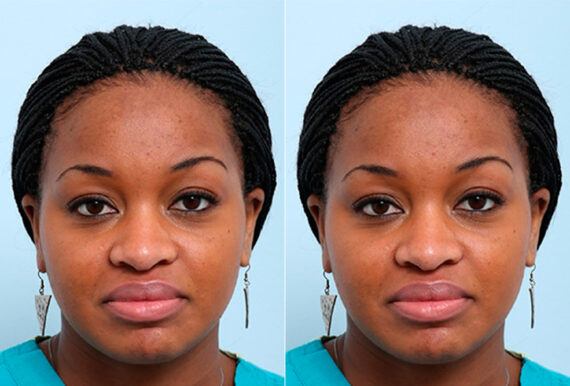 Buccal Fat Pad Removal before and after photos in Houston, TX, Patient 27873