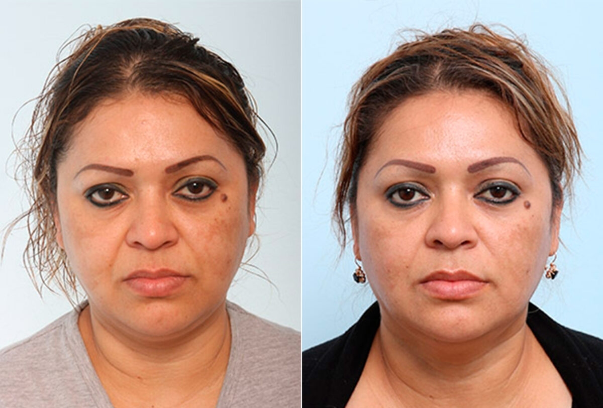 Buccal Fat Pad Removal before and after photos in Houston, TX, Patient 27880