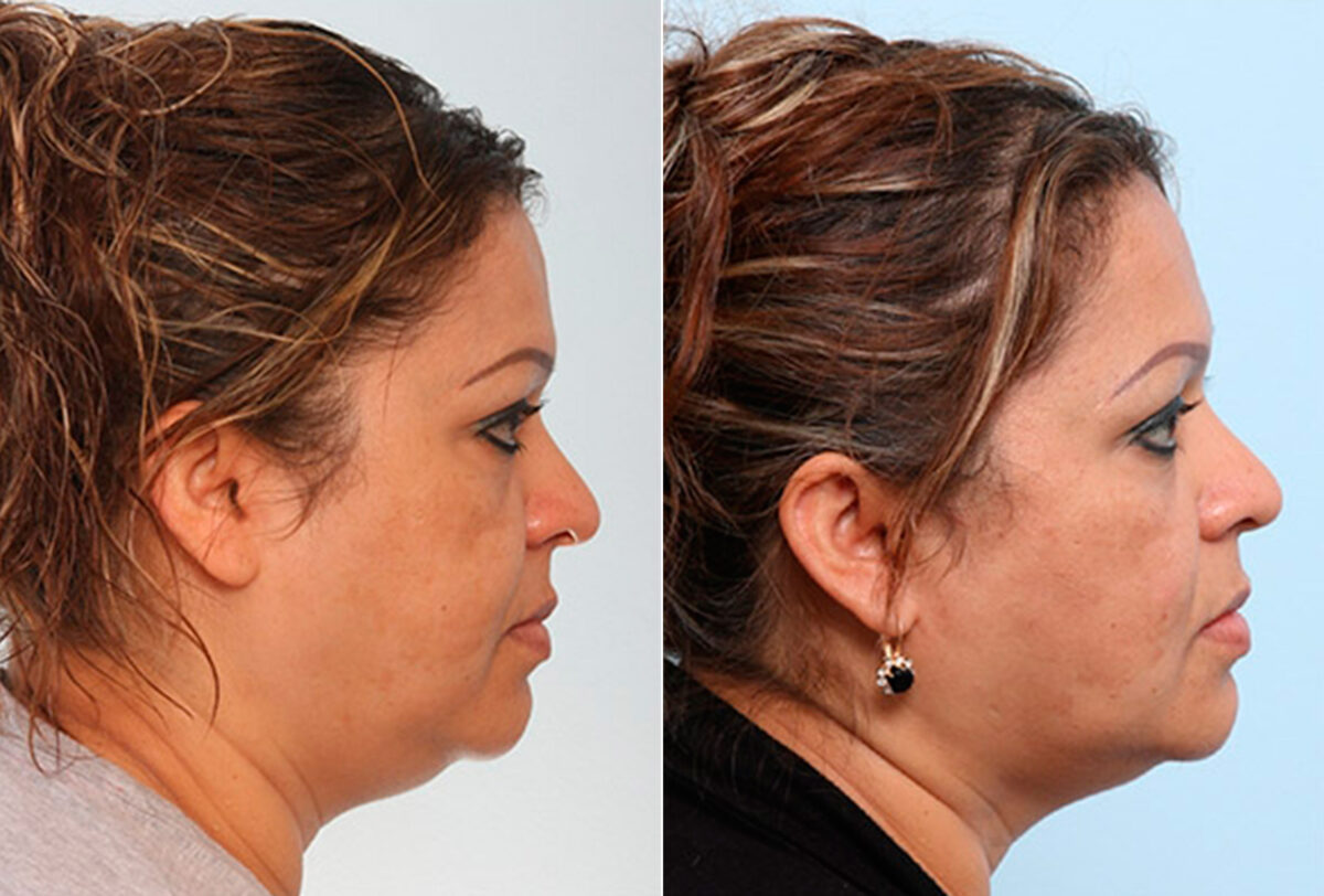 Buccal Fat Pad Removal before and after photos in Houston, TX, Patient 27880