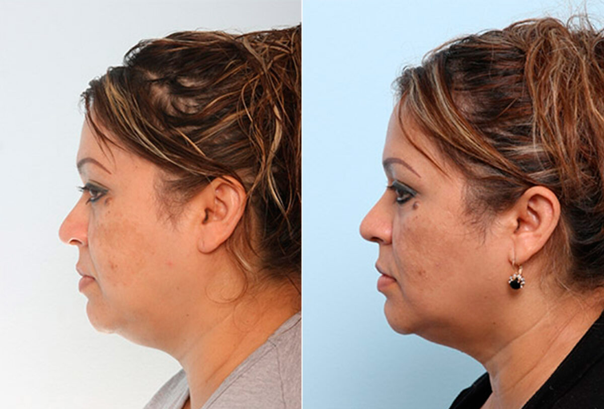 Buccal Fat Pad Removal before and after photos in Houston, TX, Patient 27880