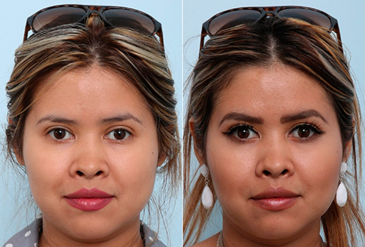 Buccal Fat Pad Removal before and after photos in Houston, TX, Patient 27887