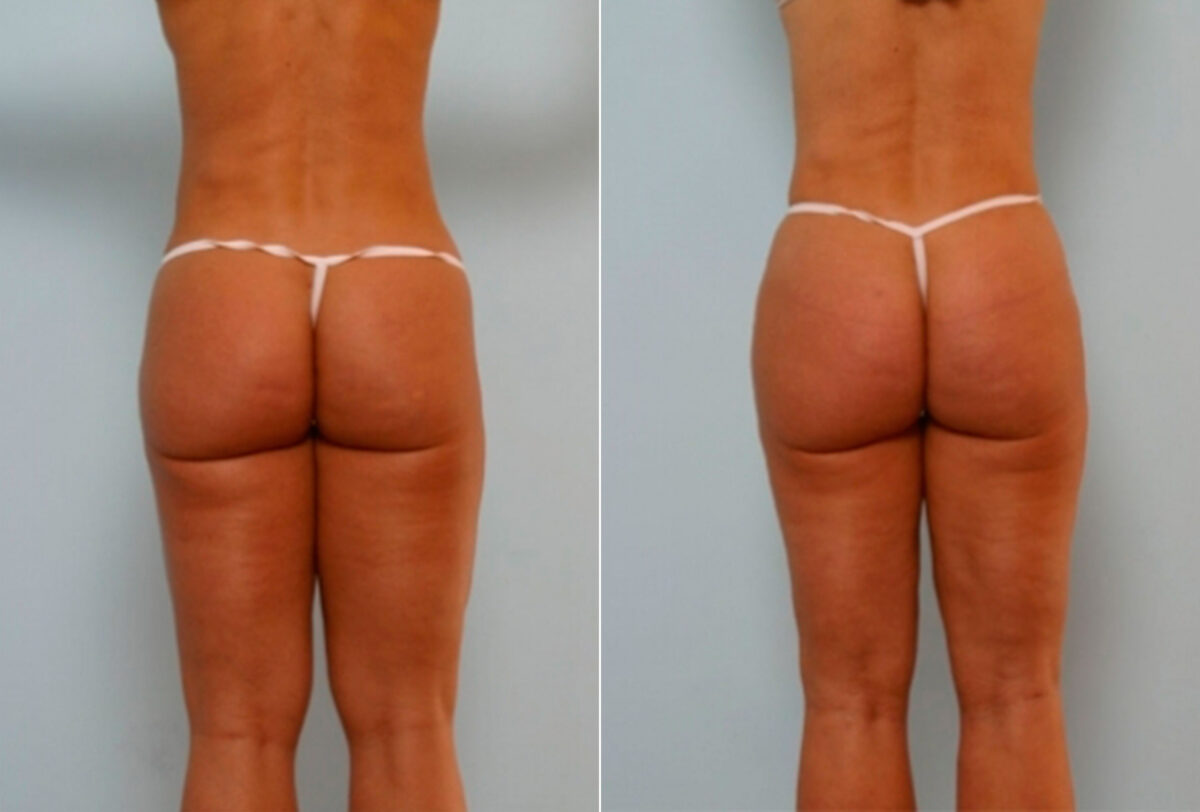 Butt Augmentation before and after photos in Houston, TX, Patient 27901