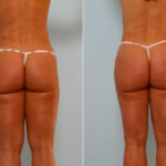 Butt Augmentation before and after photos in Houston, TX, Patient 27901