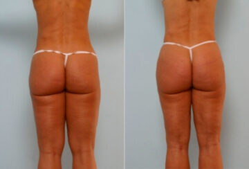 Butt Augmentation before and after photos in Houston, TX, Patient 27901