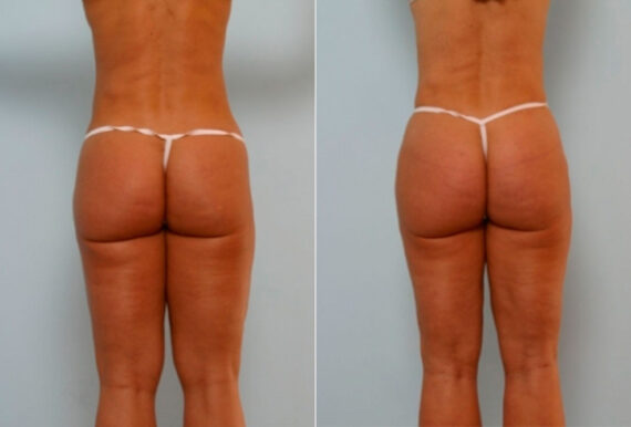 Butt Augmentation before and after photos in Houston, TX