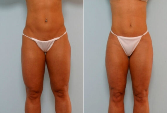Butt Augmentation before and after photos in Houston, TX, Patient 27901