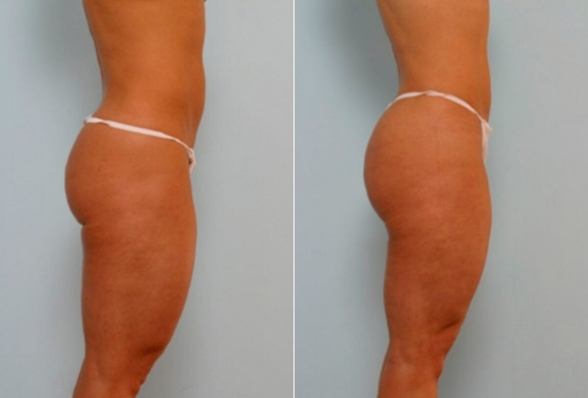 Butt Augmentation before and after photos in Houston, TX, Patient 27901