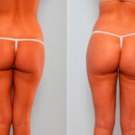 Butt Augmentation before and after photos in Houston, TX, Patient 27908