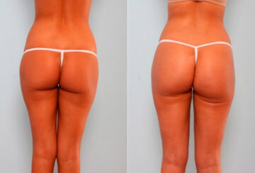 Butt Augmentation before and after photos in Houston, TX, Patient 27908