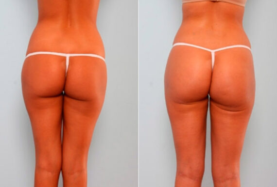 Butt Augmentation before and after photos in Houston, TX