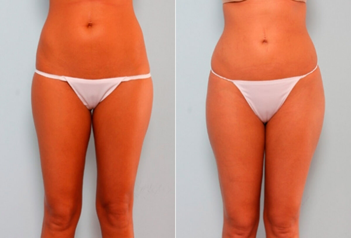 Butt Augmentation before and after photos in Houston, TX, Patient 27908