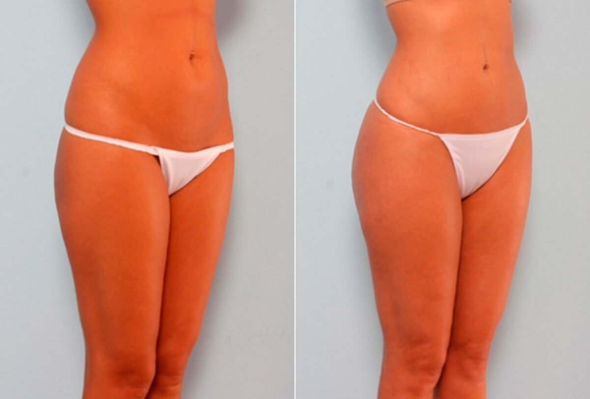 Butt Augmentation before and after photos in Houston, TX, Patient 27908