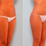 Butt Augmentation before and after photos in Houston, TX, Patient 27908