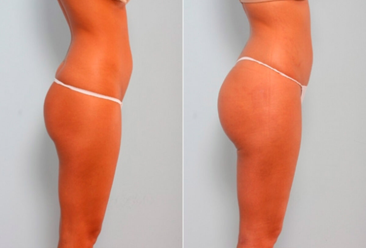 Butt Augmentation before and after photos in Houston, TX, Patient 27908