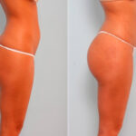 Butt Augmentation before and after photos in Houston, TX, Patient 27908