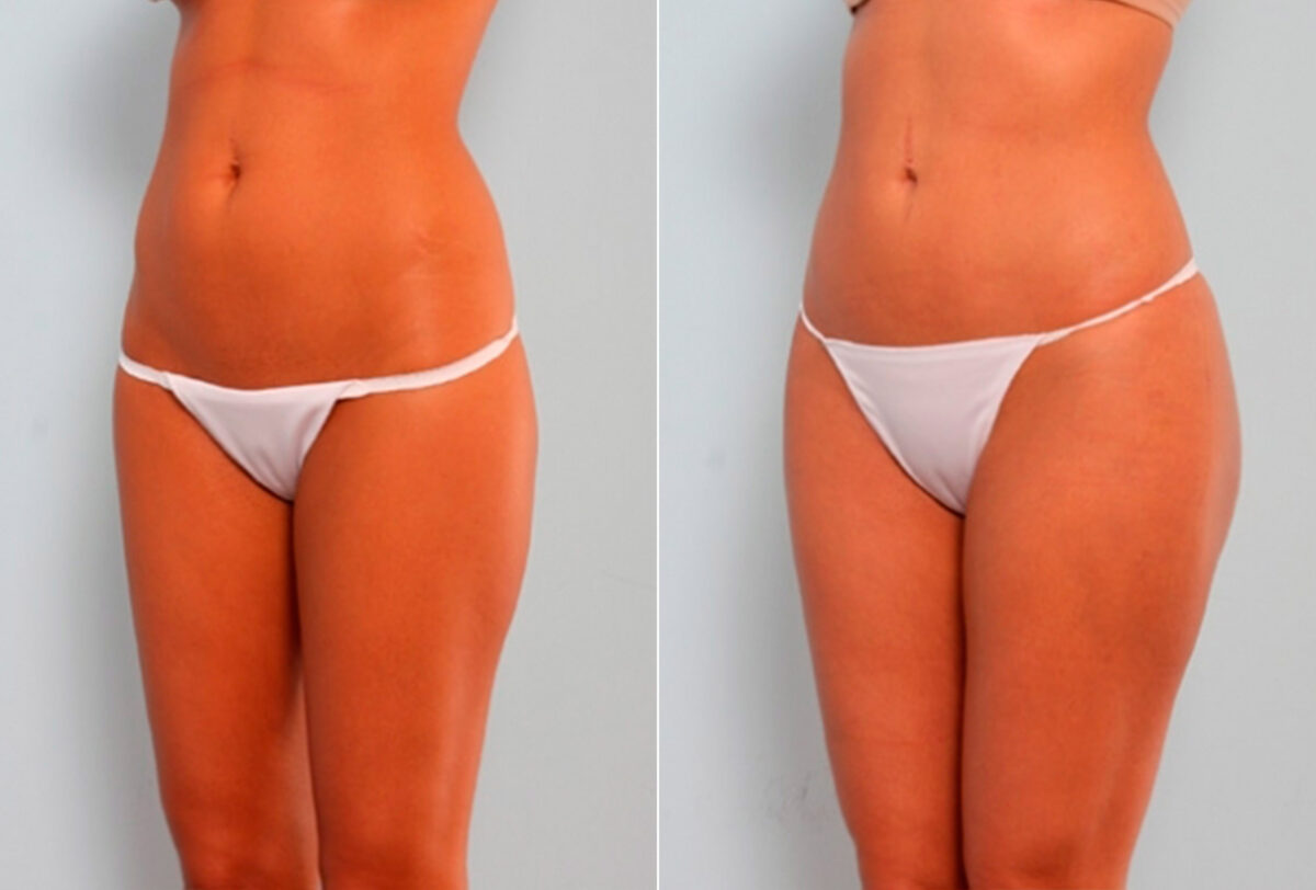 Butt Augmentation before and after photos in Houston, TX, Patient 27908