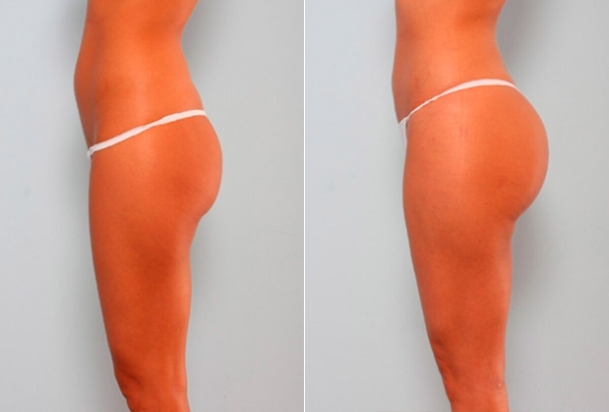 Butt Augmentation before and after photos in Houston, TX, Patient 27908