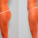 Butt Augmentation before and after photos in Houston, TX, Patient 27908