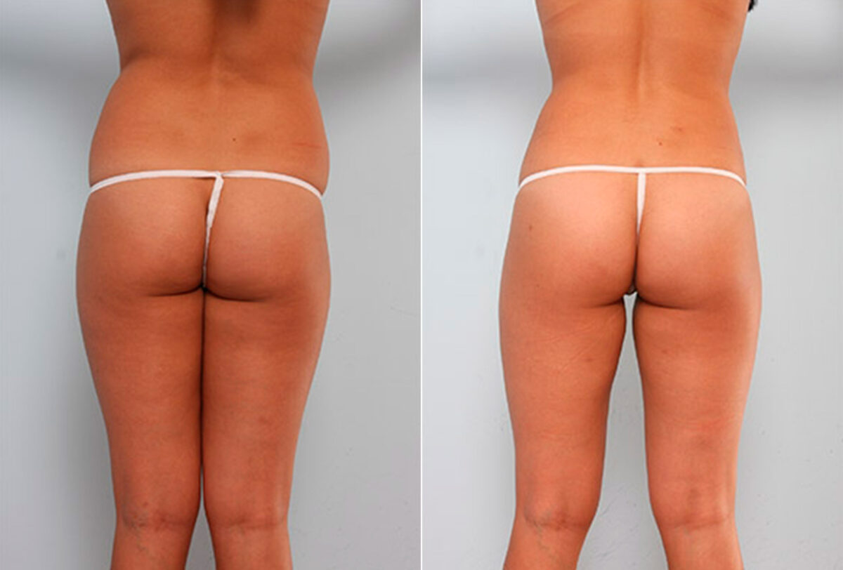Patient 27921, Butt Augmentation before and after photos Butt Augmentation before and after photos in Houston, TX, Patient 27921