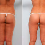 Butt Augmentation before and after photos in Houston, TX, Patient 27921