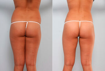 Butt Augmentation before and after photos in Houston, TX, Patient 27921