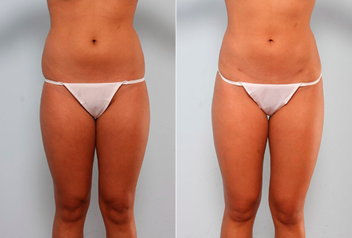 Butt Augmentation before and after photos in Houston, TX, Patient 27921