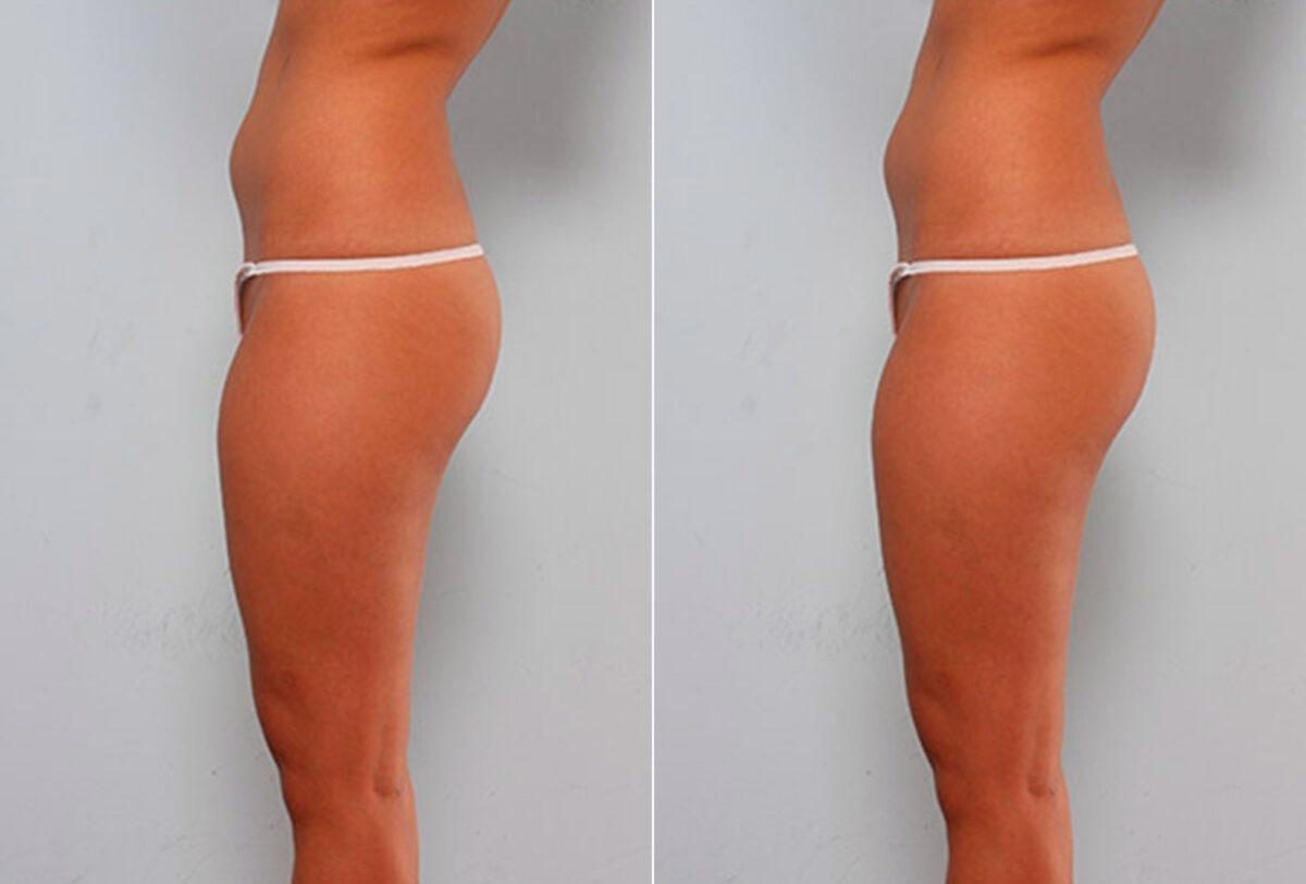 Butt Augmentation before and after photos in Houston, TX, Patient 27921