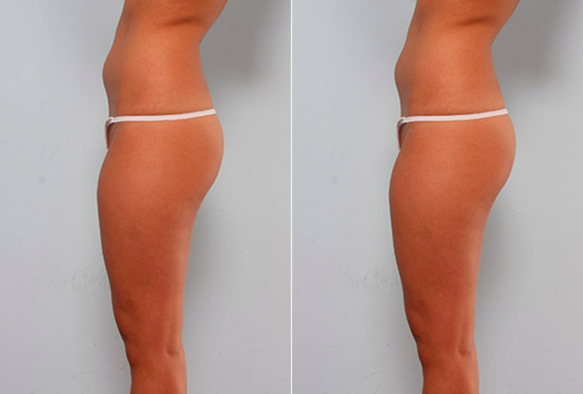 Butt Augmentation before and after photos in Houston, TX, Patient 27921