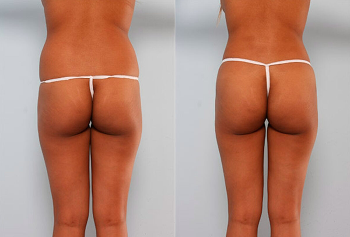 Patient 27928, Butt Augmentation before and after photos Butt Augmentation before and after photos in Houston, TX, Patient 27928