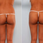 Butt Augmentation before and after photos in Houston, TX, Patient 27928