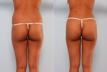 Butt Augmentation before and after photos in Houston, TX, Patient 27928